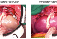 Supercooled kidneys have been transplanted into pigs in a “landmark achievement”