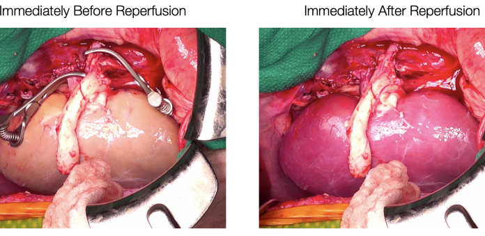 Supercooled kidneys have been transplanted into pigs in a “landmark achievement”